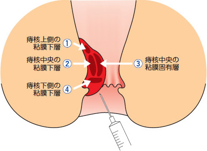 肛門周囲のイメージ画像